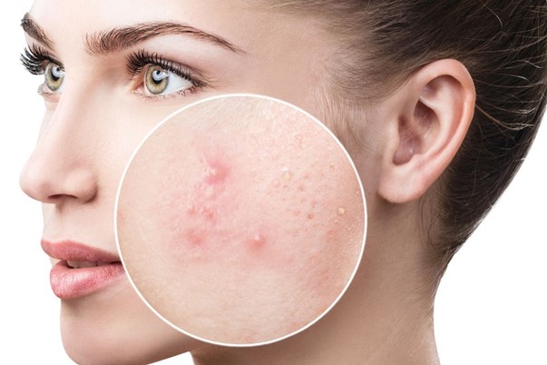 Rau má có tác dụng trị mụn cho da mặt