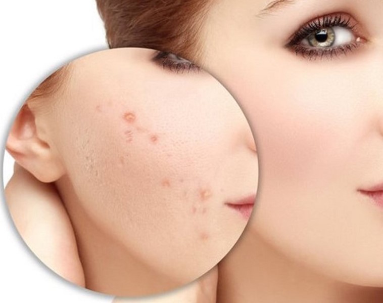 Rau má có tác dụng làm liền sẹo cho da mặt