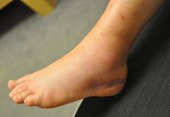cách chữa gai gót chân bằng lá lốt